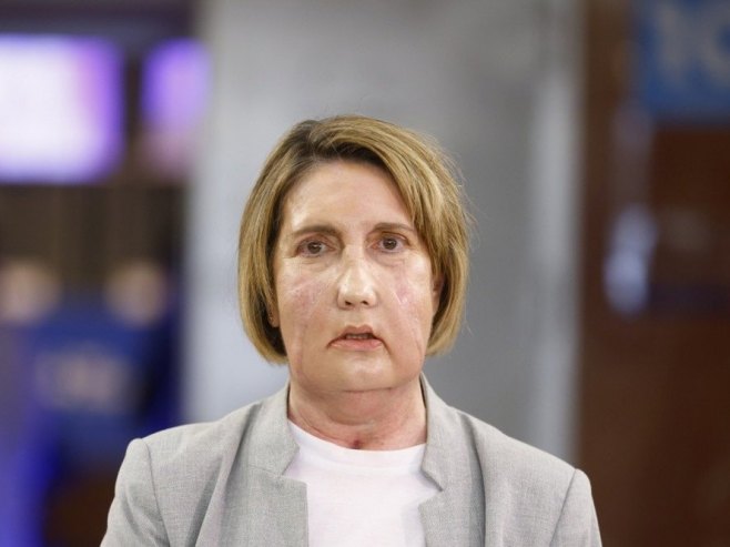 Кармен, прва особа на свијету којој је лице трансплантирано са еутаназираног донора (Фото: EPA/Quique Garcíia) Кармен, прва особа на свијету којој је лице трансплантирано са еутаназираног донора (Фото: EPA/Quique Garcíia) -