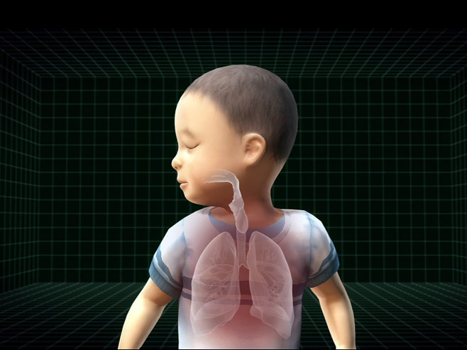 3D имплант спасао живот дјечацима - Фото: Screenshot/YouTube