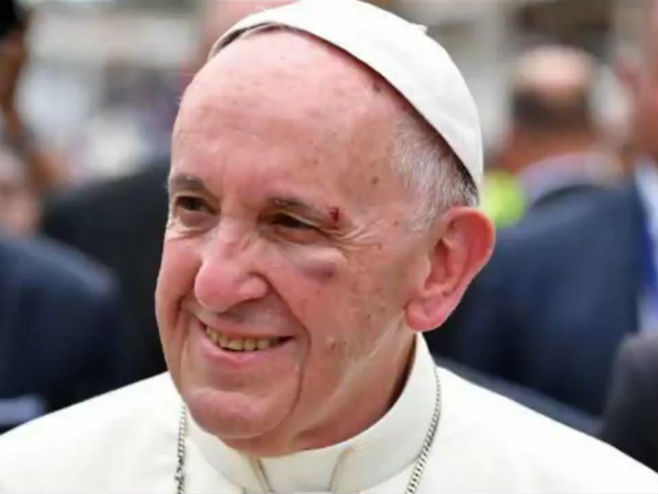 Папа Фрањо зарадио модрицу на оку - Фото: Screenshot